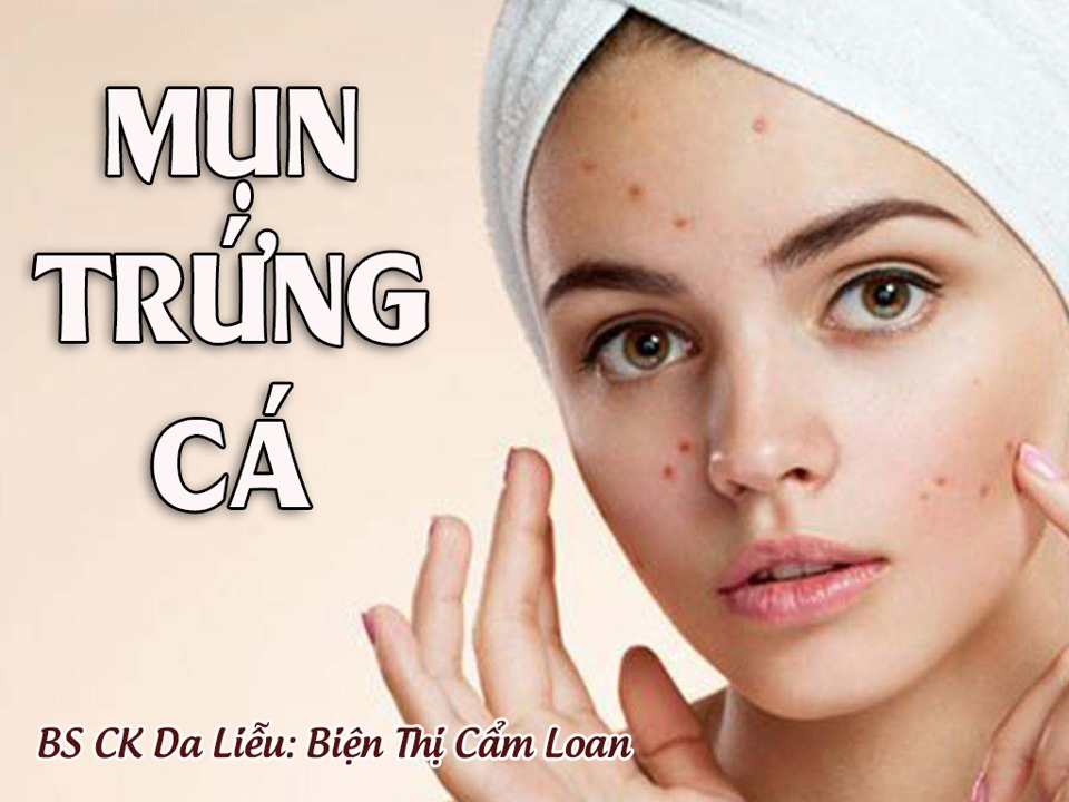 MỤN TRỨNG CÁ